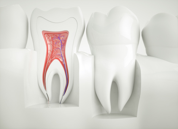 What is a Root Canal and When Do I Need One?